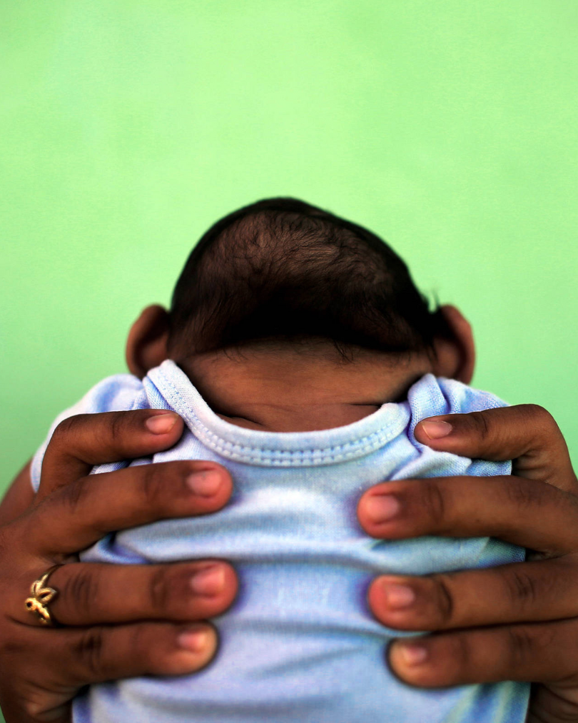 criança com microcefalia por zika
