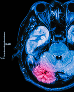 Você reconheceria uma AVC rapidamente? Faça o teste.